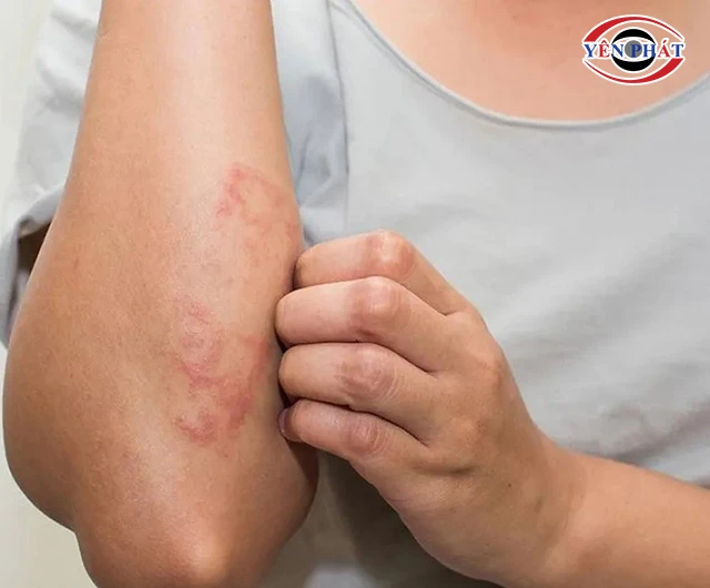 Lông chó mèo gây kích thích dị ứng