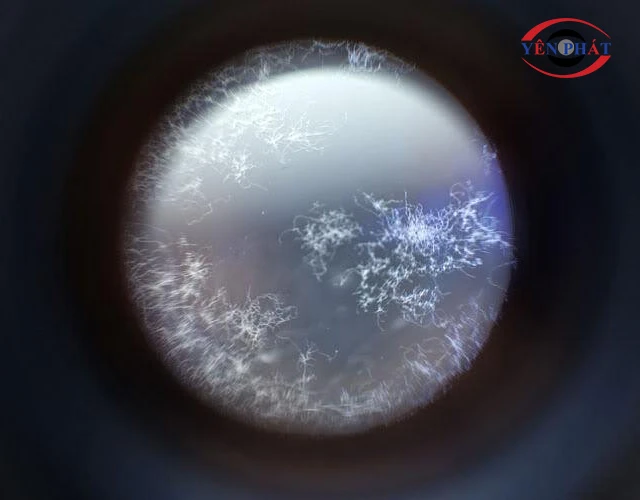 Hình ảnh lens bị mốc