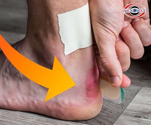 giày da cứng làm đau chân