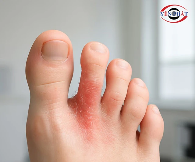 chân bị viêm do giày sneaker bẩn